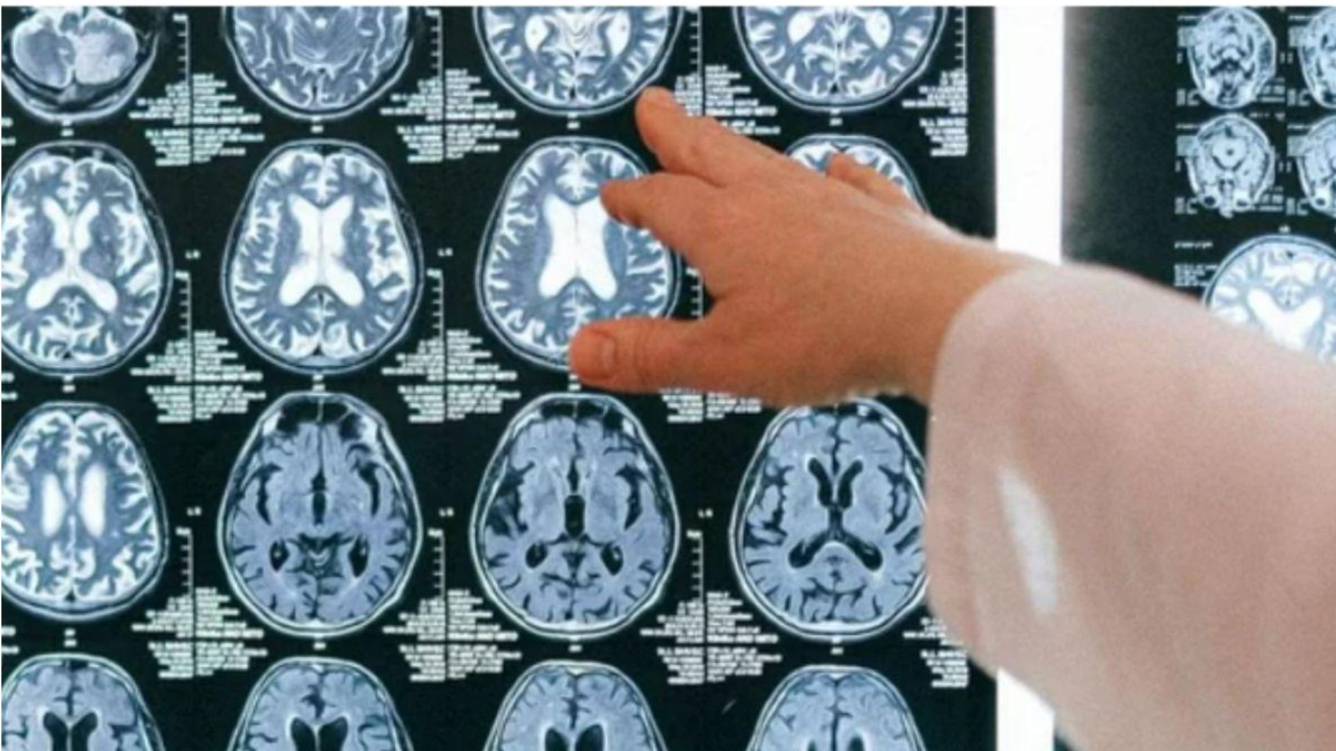 Raio x c&eacute;rebro 