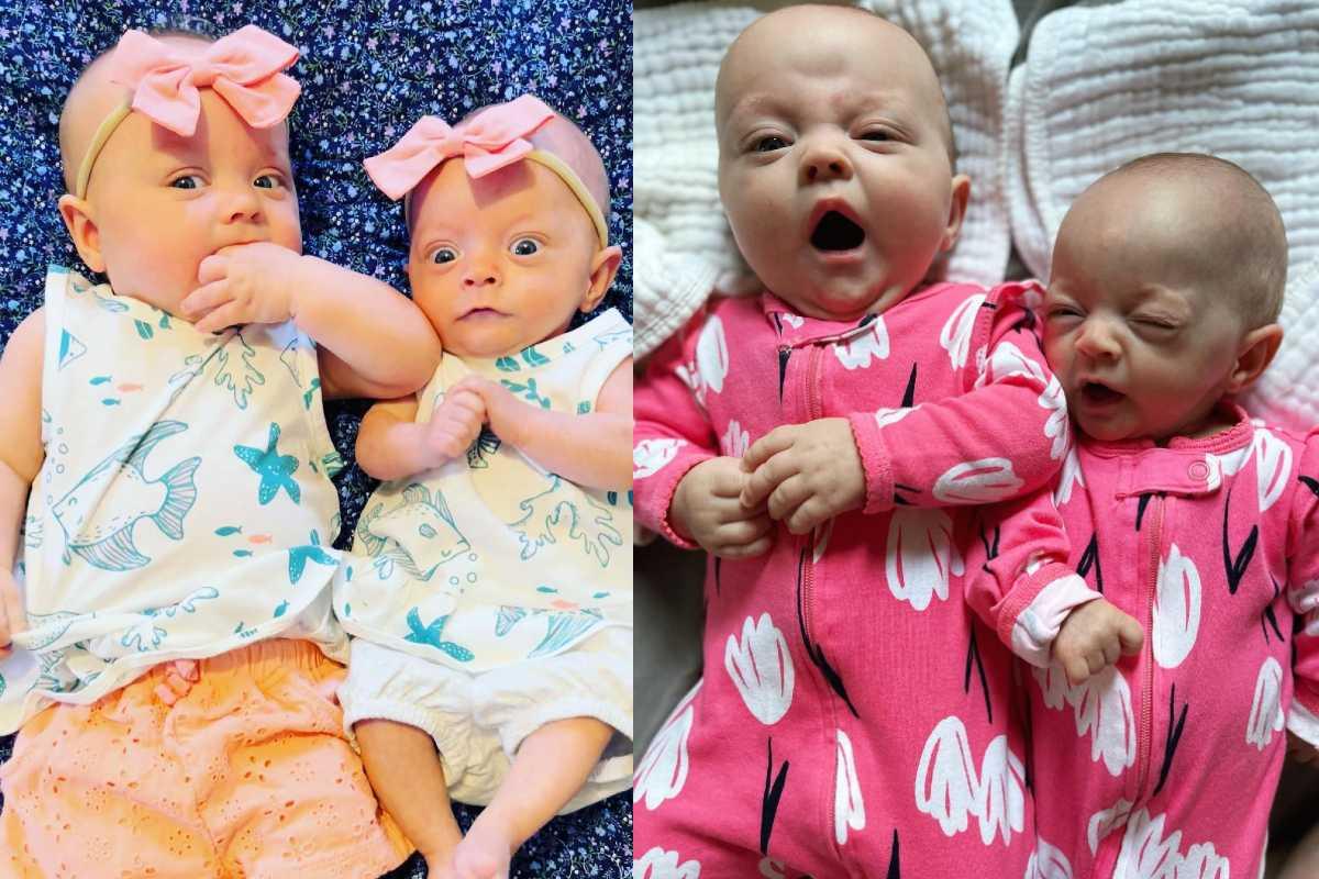 Gêmea nasce com o triplo do tamanho da irmã e mãe conta história de superação