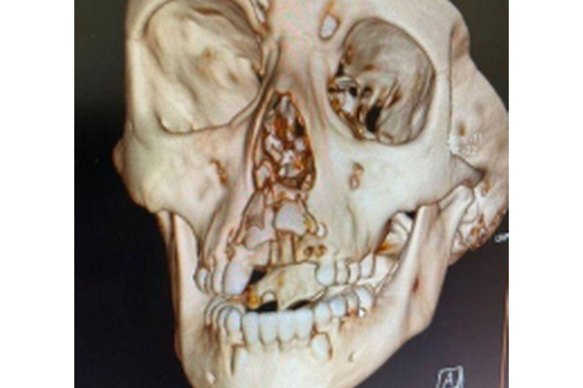 Menina de 10 anos sofreu diversas fraturas após se machucar em tobogã