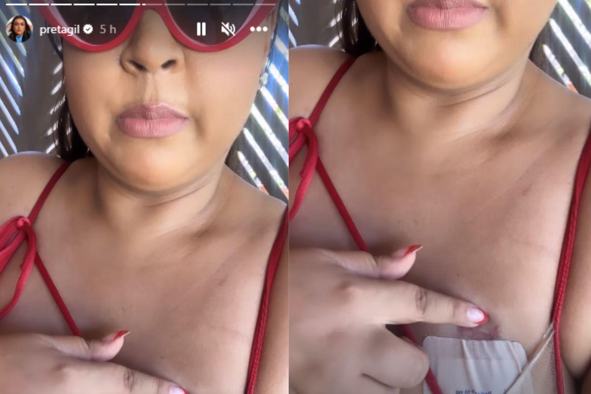 Preta Gil explicando hematomas na região do seio 