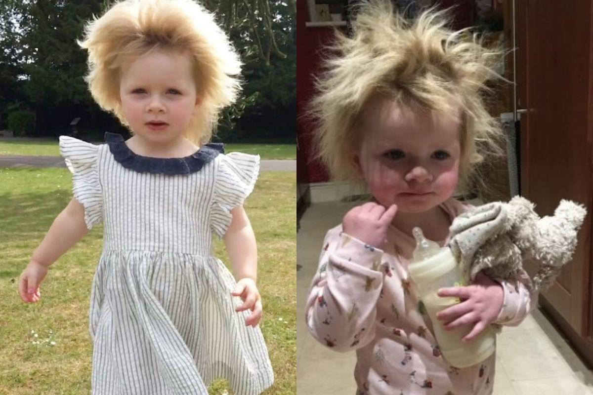 O cabelo da menina é impossível de pentear por causa da síndrome