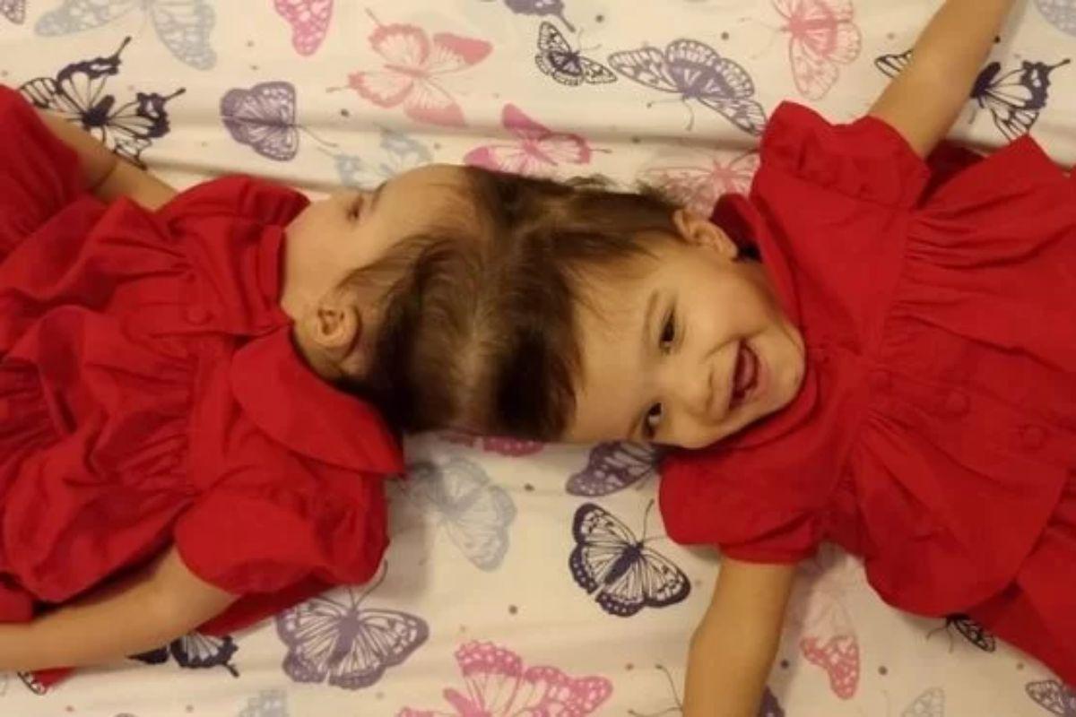 Gêmeas siamesas são separadas