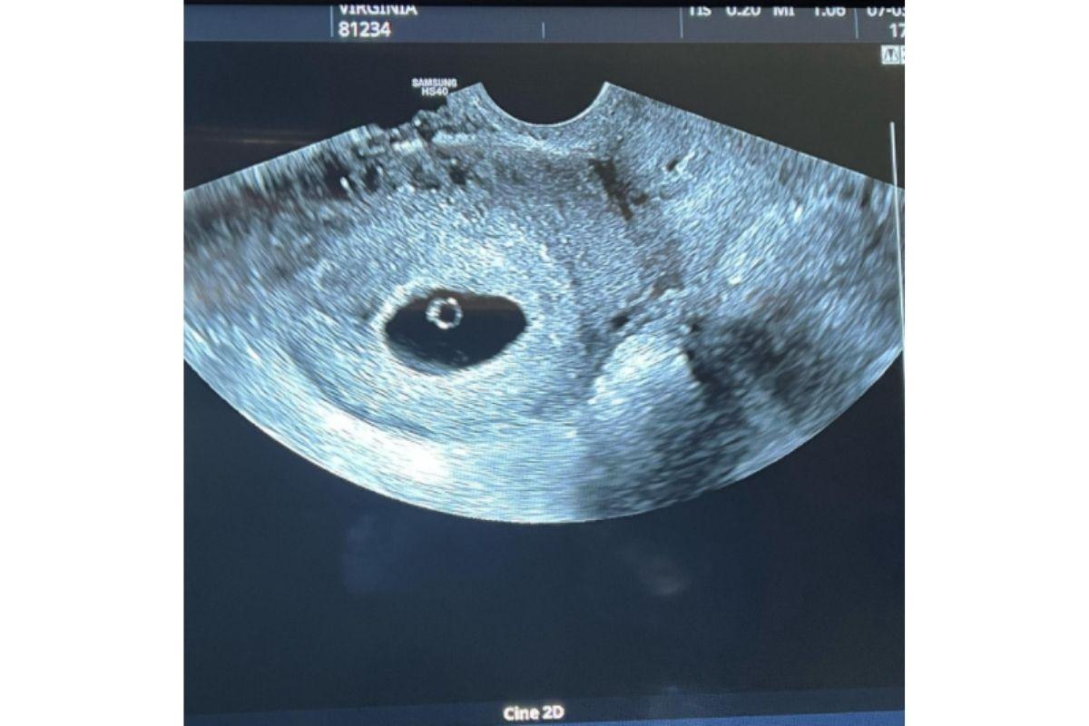 Virginia mostra primeira ultrassom da segunda gravidez