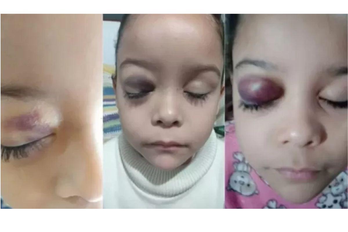 Menina de 7 anos passa por cirurgia para salvar a visão dela