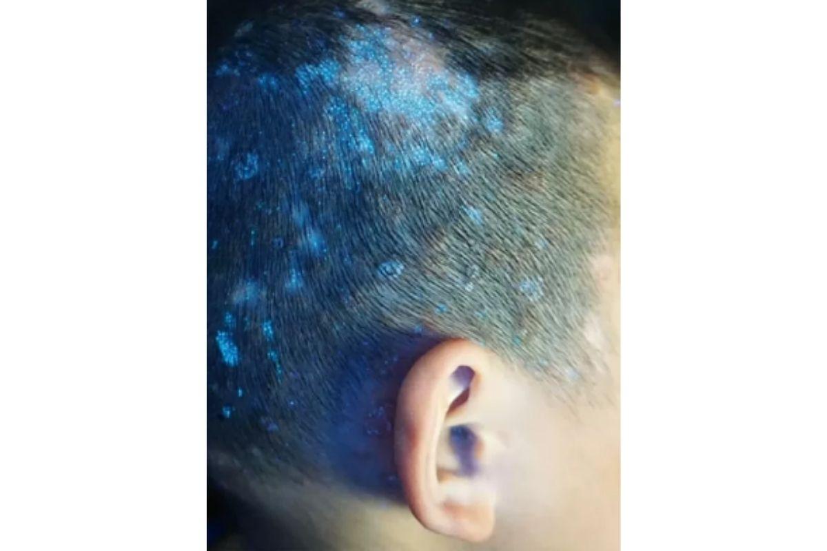 Menino fica com couro cabeludo brilhante após ser infectado por fungos