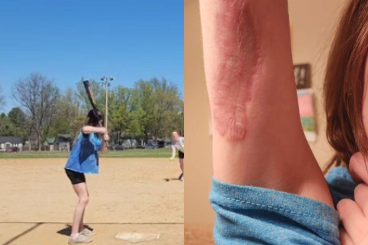 Picada de aranha, não era etiqueta da roupa, mãe acha que etiqueta da roupa estava pinicando, mas era picada de aranha, picada de aranha marrom