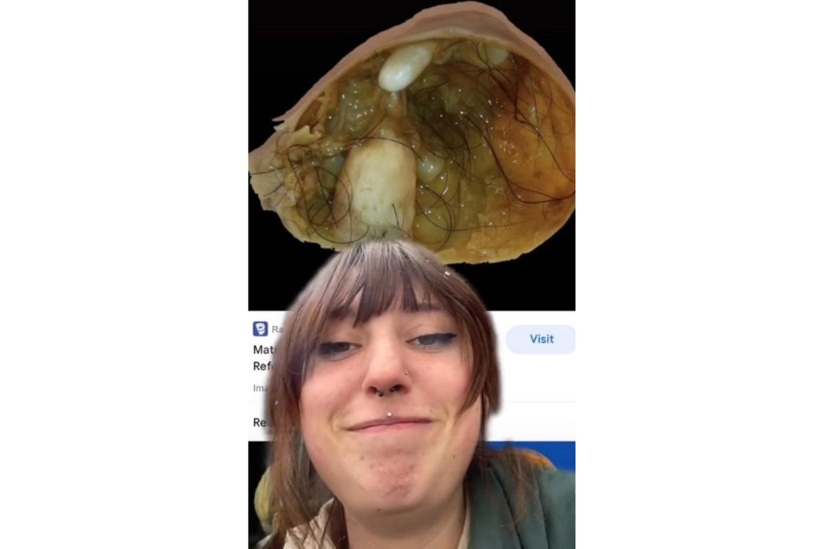 O cisto da mulher a surpreendeu