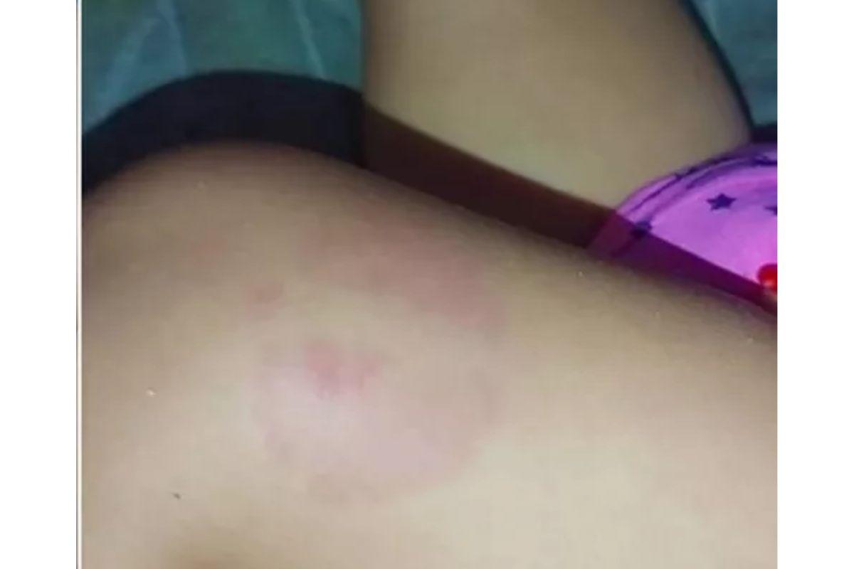 A menina de 1 ano e 5 meses estava com cerca de 8 marcas de mordidas