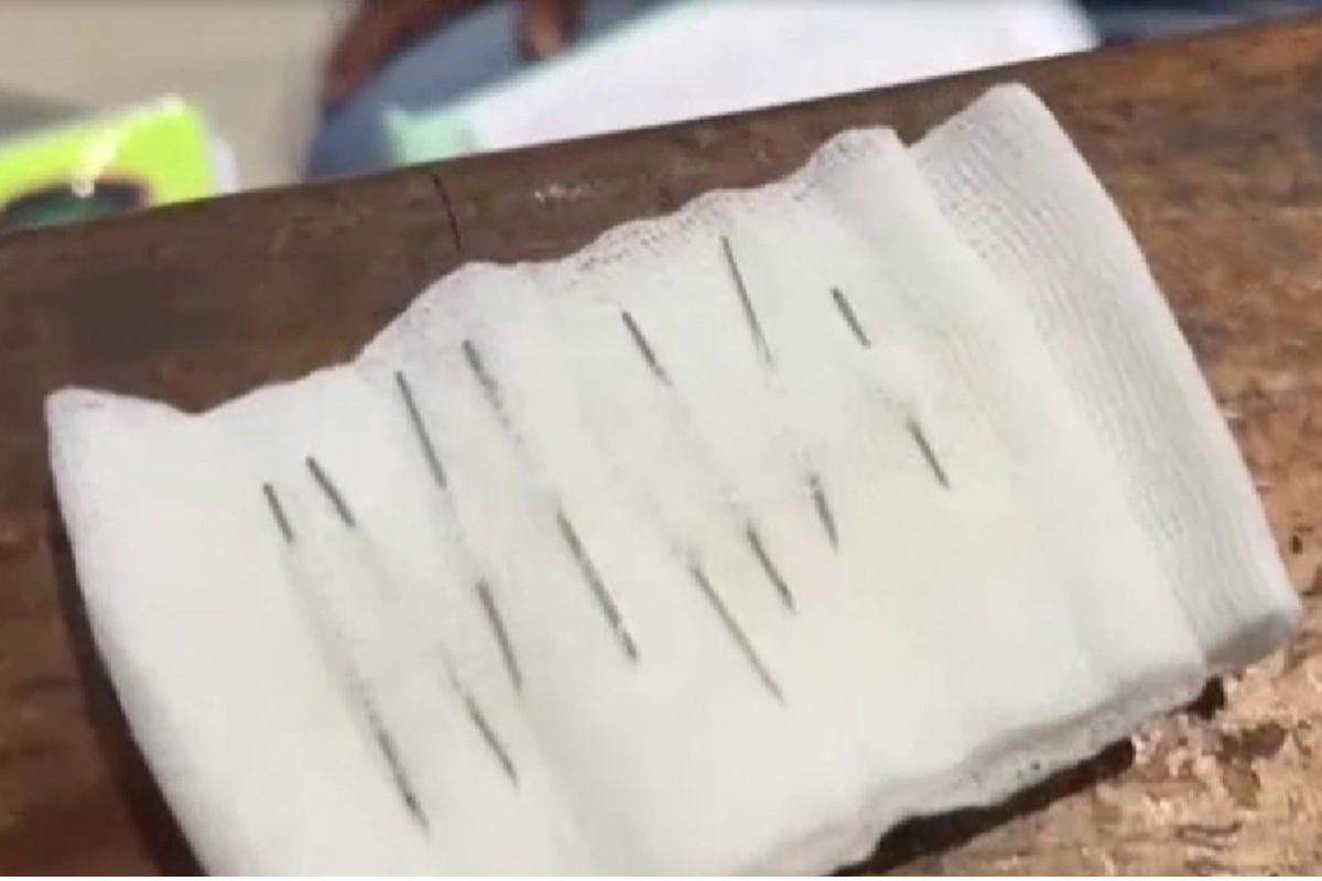 Menino de dois anos engole 8 agulhas