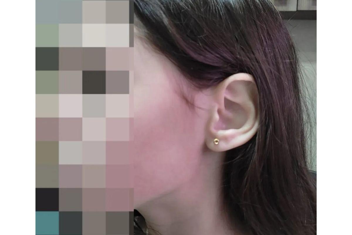 Rosto da menina de 11 anos após sofrer agressão 