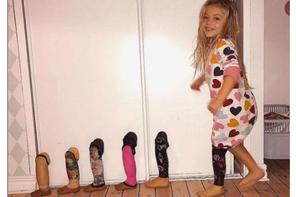 menina-perna-amputada