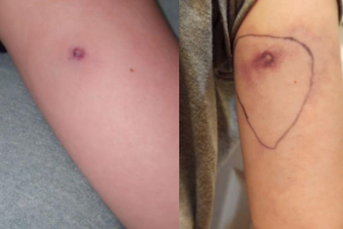 Picada de aranha, não era etiqueta da roupa, mãe acha que etiqueta da roupa estava pinicando, mas era picada de aranha, picada de aranha marrom