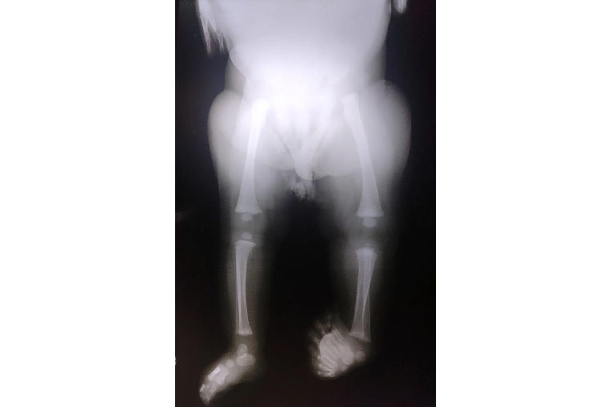 A condição só foi descoberta após o nascimento dela