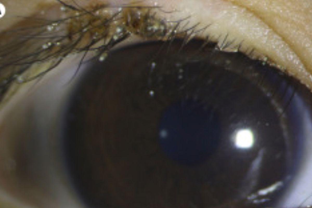 Menino de três anos tem infecção no cílios