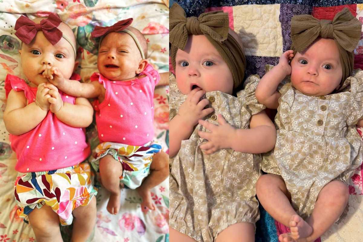 As gêmeas quando nasceram e agora: elas ainda têm tamanhos diferentes