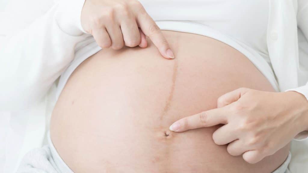 O que é a linha Nigra e por que ela aparece?"