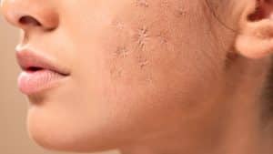 Os Tratamentos Mais Poderosos Contra Manchas na Pele que Você Precisa Conhecer!
