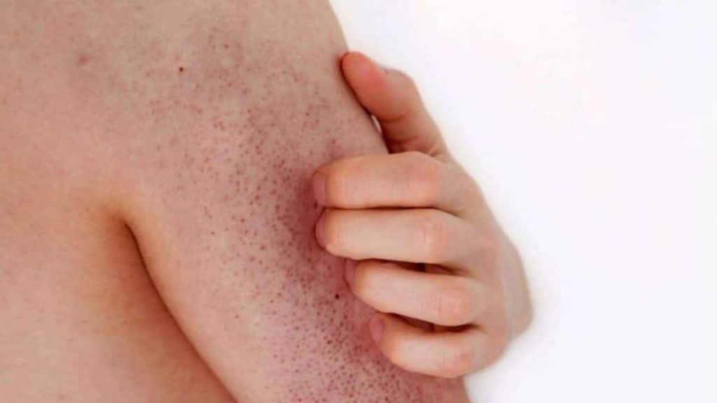 Bolinhas na pele: o que é a queratose pilar e como tratar?
