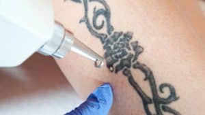 A remoção de tatuagens, é possível apagar completamente?