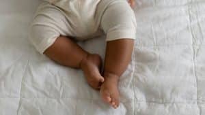 Bebê com displasia de quadril.